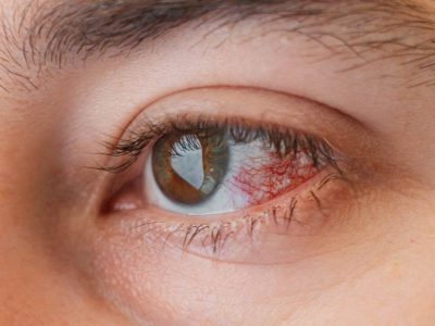 Keratitis