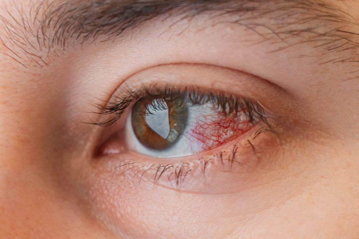 Keratitis