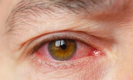 Penyakit Uveitis Gejala, Penyebab Dan Cara Penanganannya