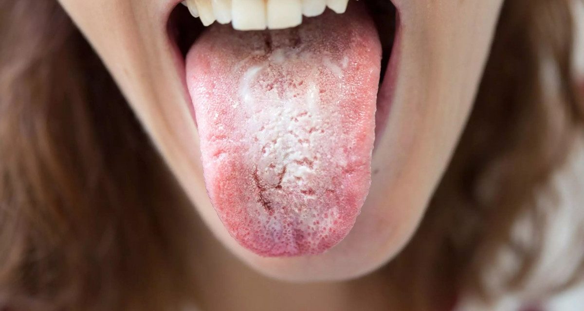 Candidiasis Infeksi Jamur Yang Perlu Di Waspadai