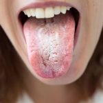 Candidiasis Infeksi Jamur Yang Perlu Di Waspadai