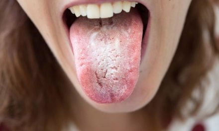 Candidiasis Infeksi Jamur Yang Perlu Di Waspadai