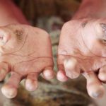 Penyakit Lepra Bisa Sebabkan Kerusakan Permanen Pada Saraf