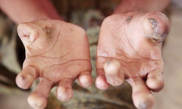 Penyakit Lepra Bisa Sebabkan Kerusakan Permanen Pada Saraf