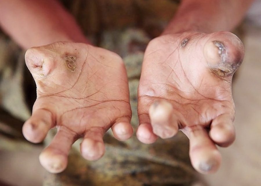 Penyakit Lepra Bisa Sebabkan Kerusakan Permanen Pada Saraf