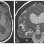 Penyakit Hydrocephalus, Kondisi Medis Dengan Cairan Di Otak