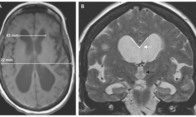 Penyakit Hydrocephalus, Kondisi Medis Dengan Cairan Di Otak