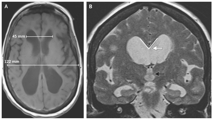 Penyakit Hydrocephalus, Kondisi Medis Dengan Cairan Di Otak